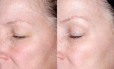 Rejuvenecimiento de la piel alrededor de los ojos antes y después de las fotos.